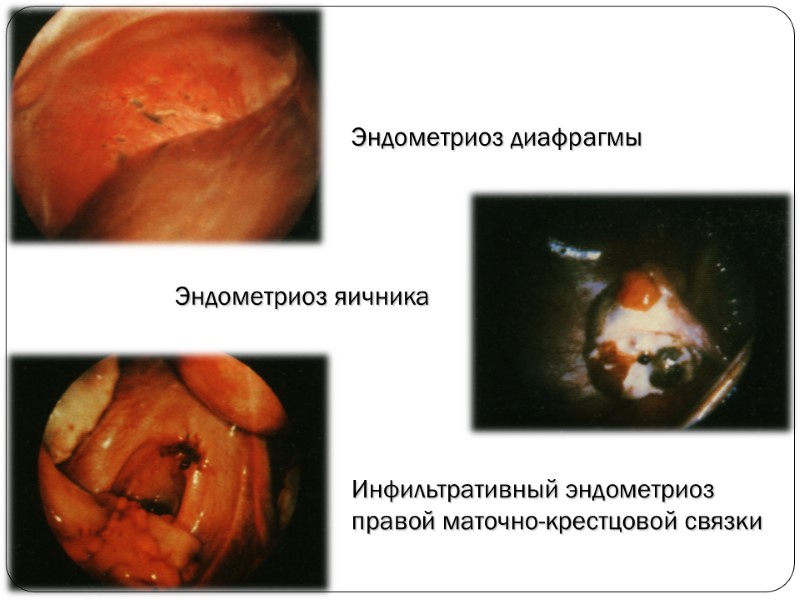 Эндометриоз диафрагмы Эндометриоз яичника Инфильтративный эндометриоз правой маточно-крестцовой связки